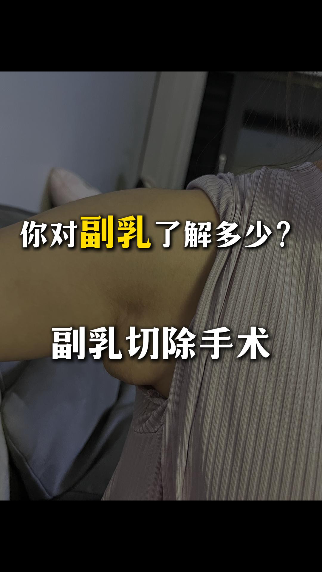 副乳科普。