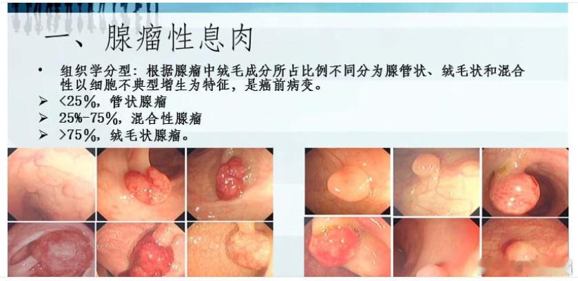 肠息肉是指高出肠黏膜的局部隆起性病变。凡是从肠黏膜表面凸向肠腔内的肿块，在未明确