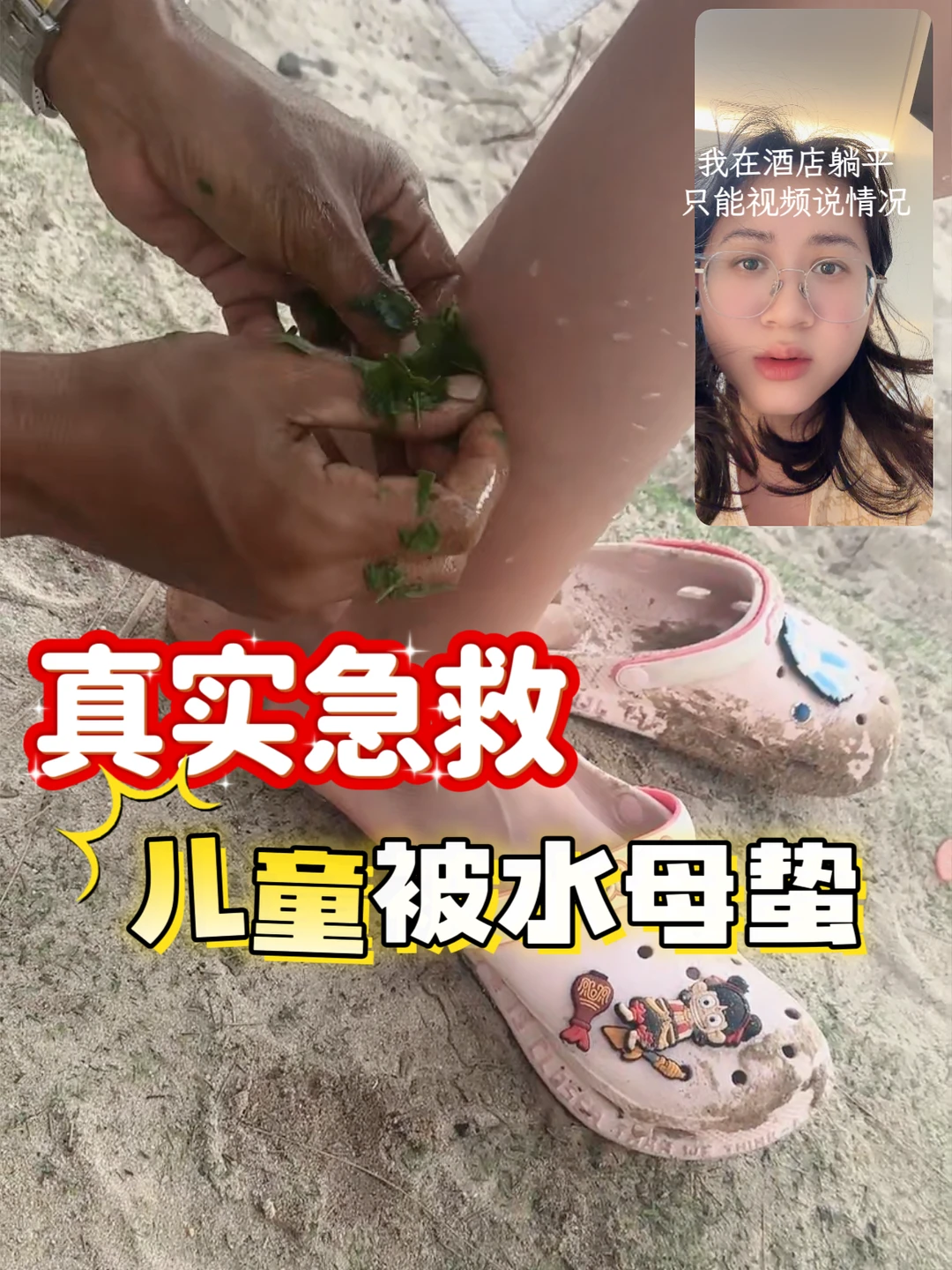 儿童被水母蛰🪼48小时有效急救🌊可下水玩啦