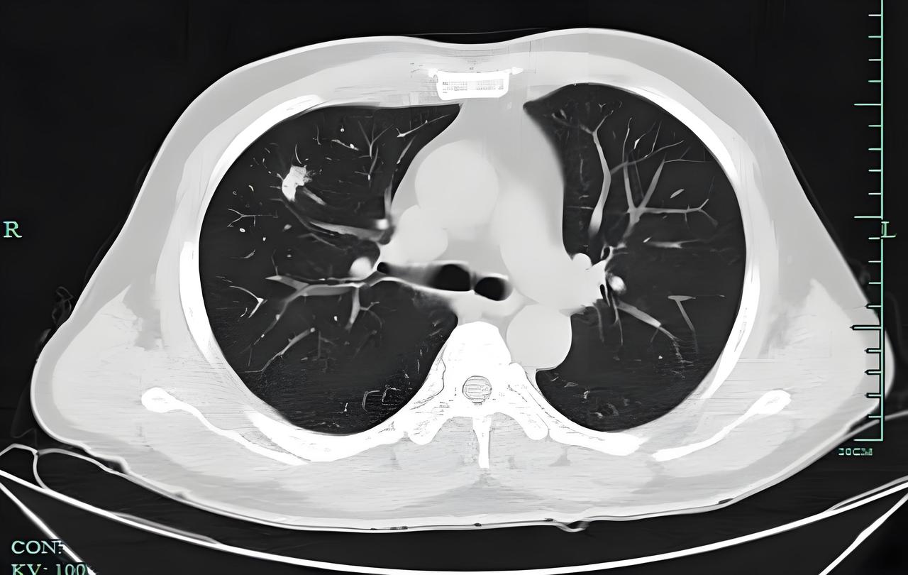 别再对着肺 CT 干瞪眼！10 大术语全解析

1、磨玻璃影
定义：CT 图像上