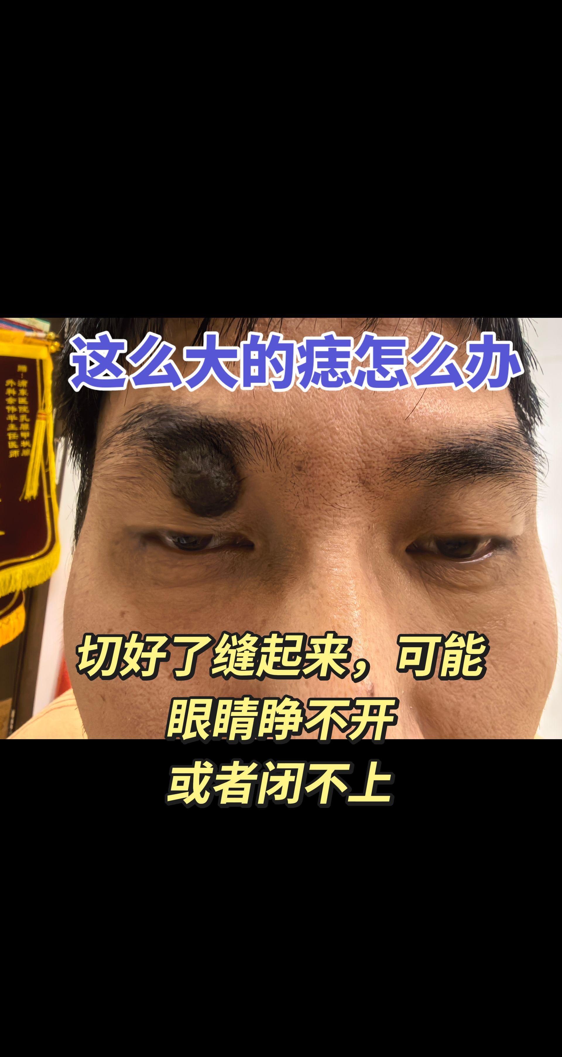 体表肿块切除。