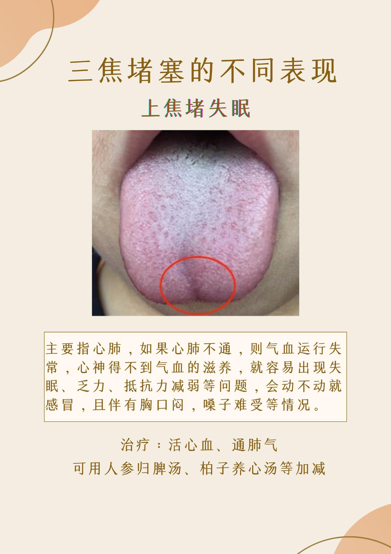 上中下三焦堵塞的表现各不相同，找准问题所在才能对症下药，快看看自己是哪一种？