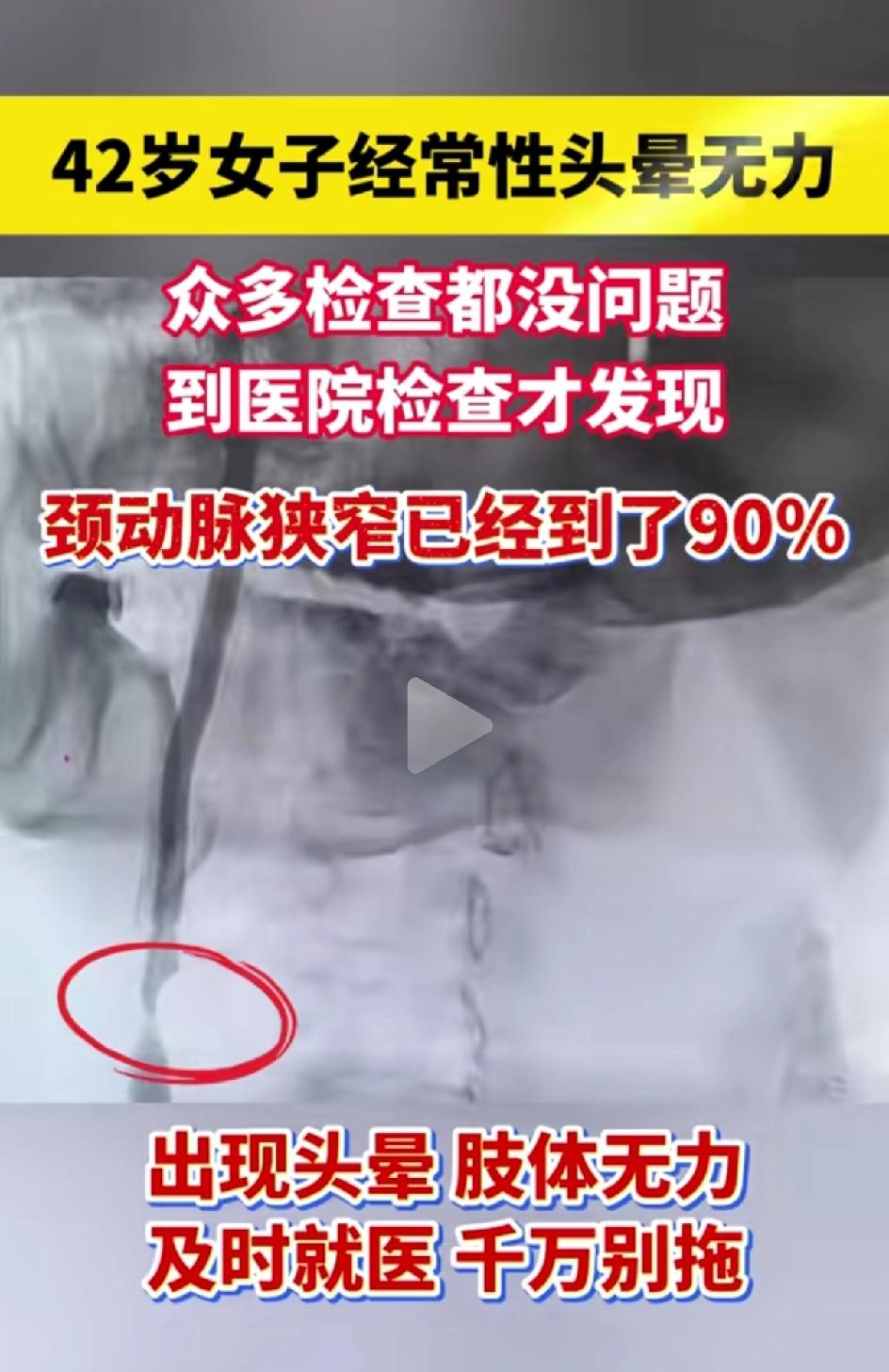 42岁女子经常现头晕无力，到医院去检查颈动脉狭窄90%。医生奉劝各位，如果感觉经