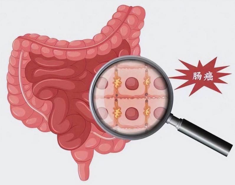 国家癌症中心专家：结直肠癌或有望成第2个被人类消灭的癌症
顿顿离不开红肉烧烤、久