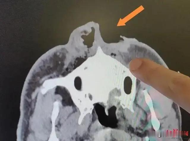 好可怕！四川甘孜，男子进深山采摘野生菌，不料，突然遇到一只黑熊，等他发现时，逃跑