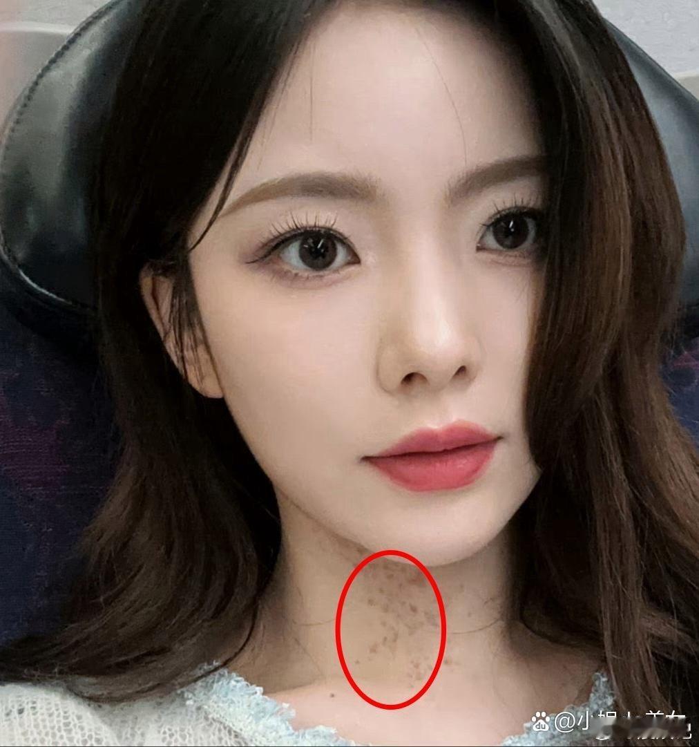 陈卓璇脖子上的痕迹是不是有影响到她演戏了？如果没有这痕迹估计会有剧本找上门，不过