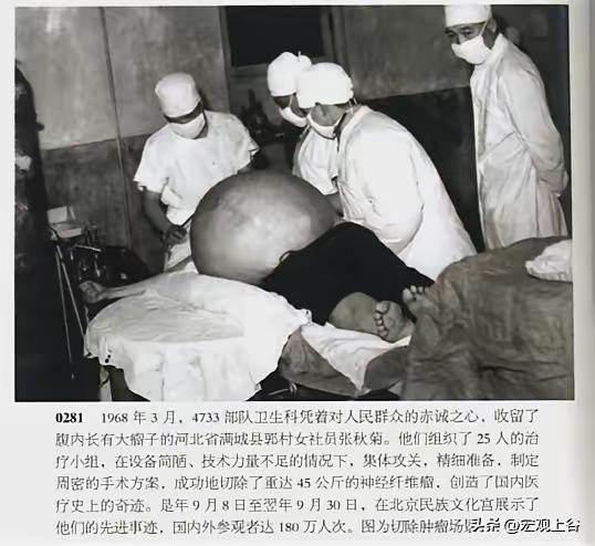 1968年，驻防保定的113师卫生科，为满城农妇张秋菊成功摘除重达90多斤的腹腔
