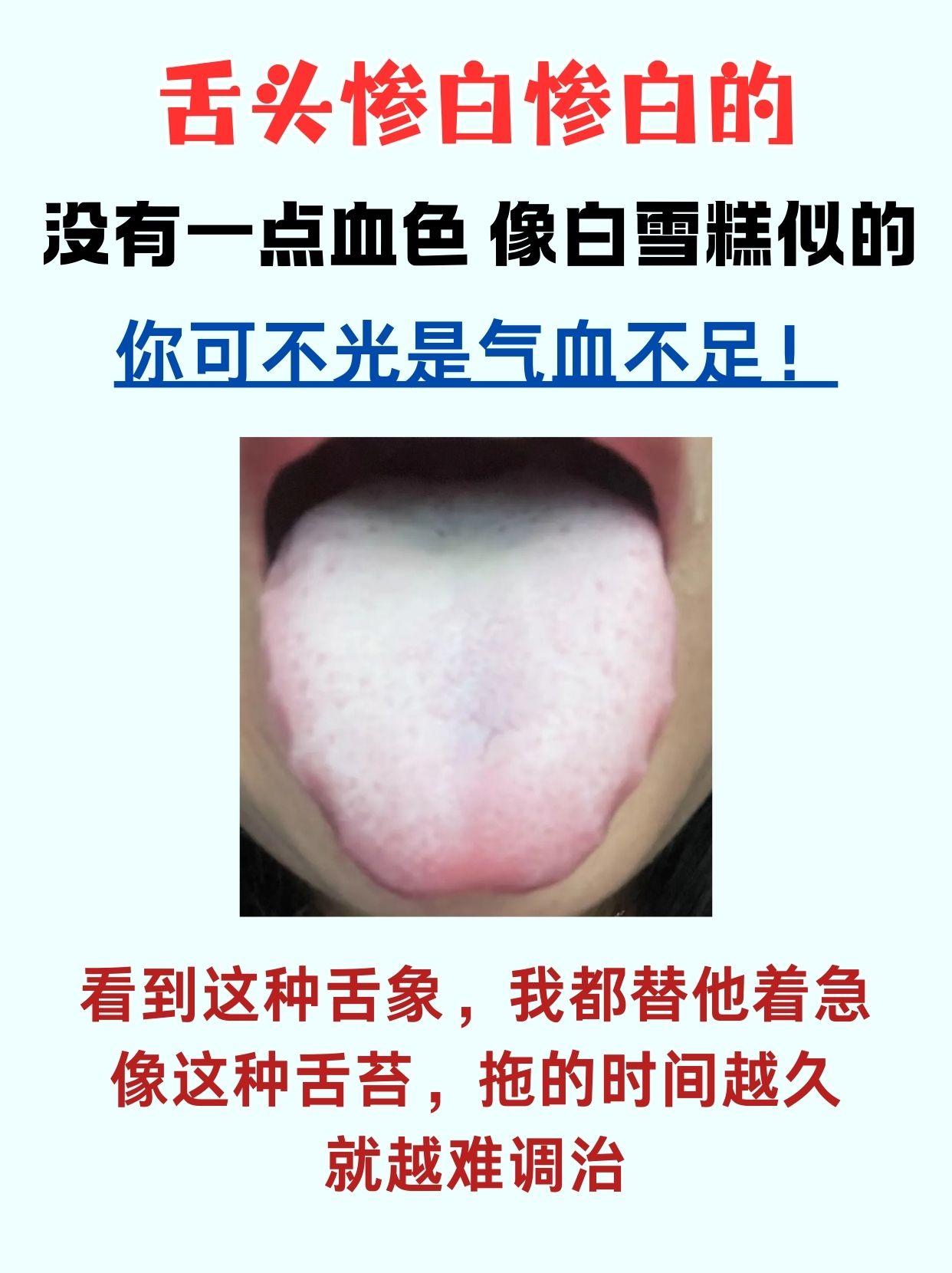 今天不忙，周末给大家舌诊分析，你留我辨证！
舌头惨白惨白的 没有一点血色 像白雪