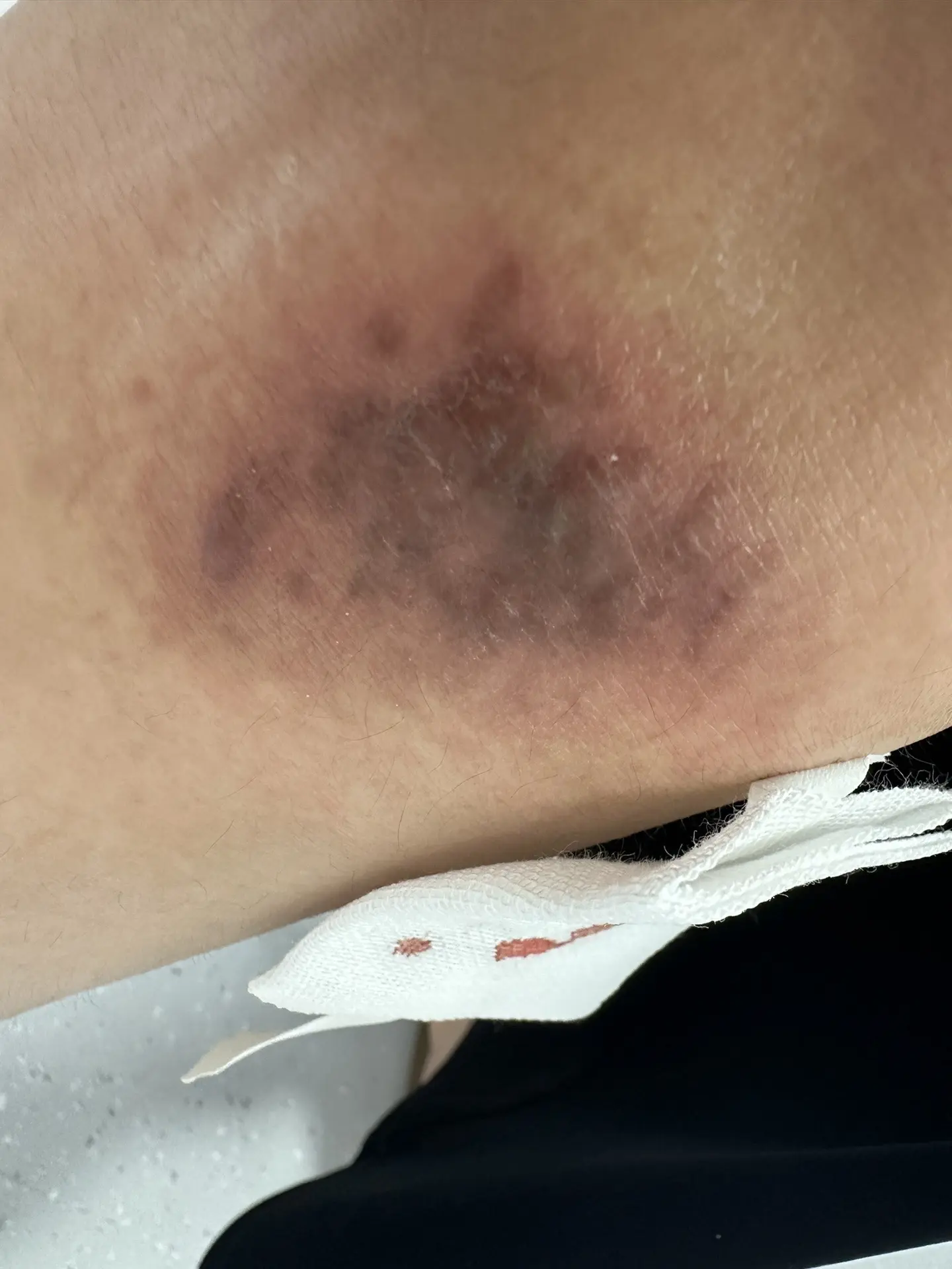 打抑制疤痕增生的针过敏了，好痒。