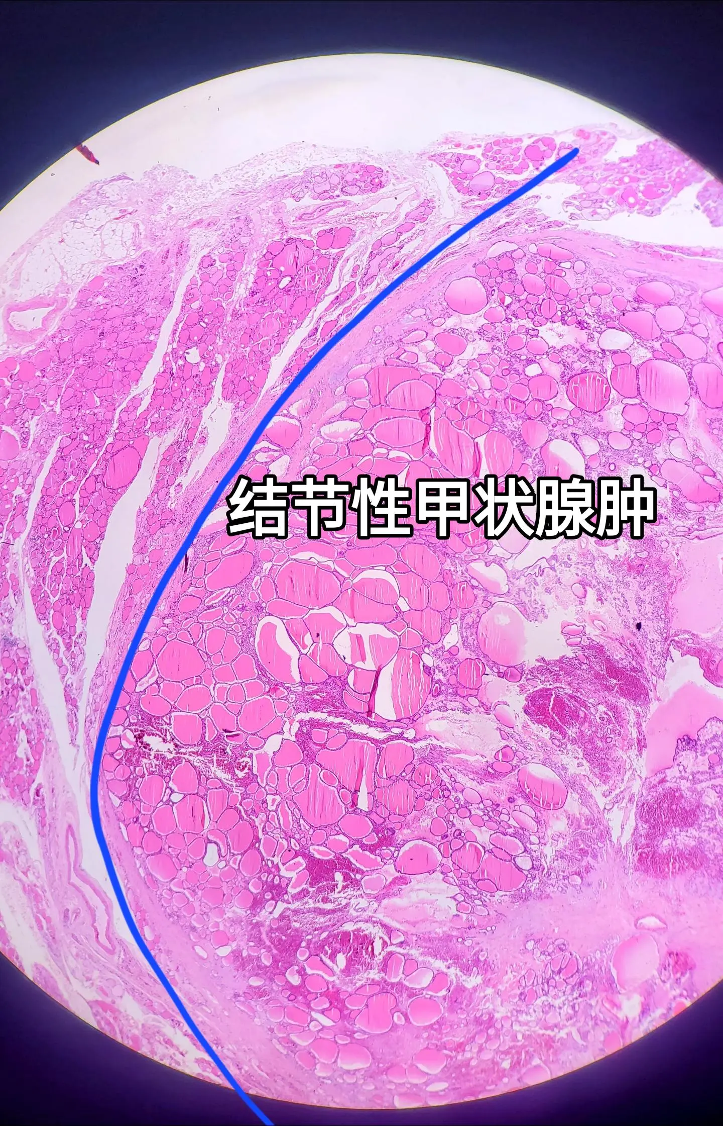 结节性甲状腺肿