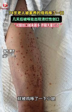 悲剧还是发生了！广东肇庆，一74岁老人喂鸡时，不慎被鸡给啄了一口，起初老人并未放