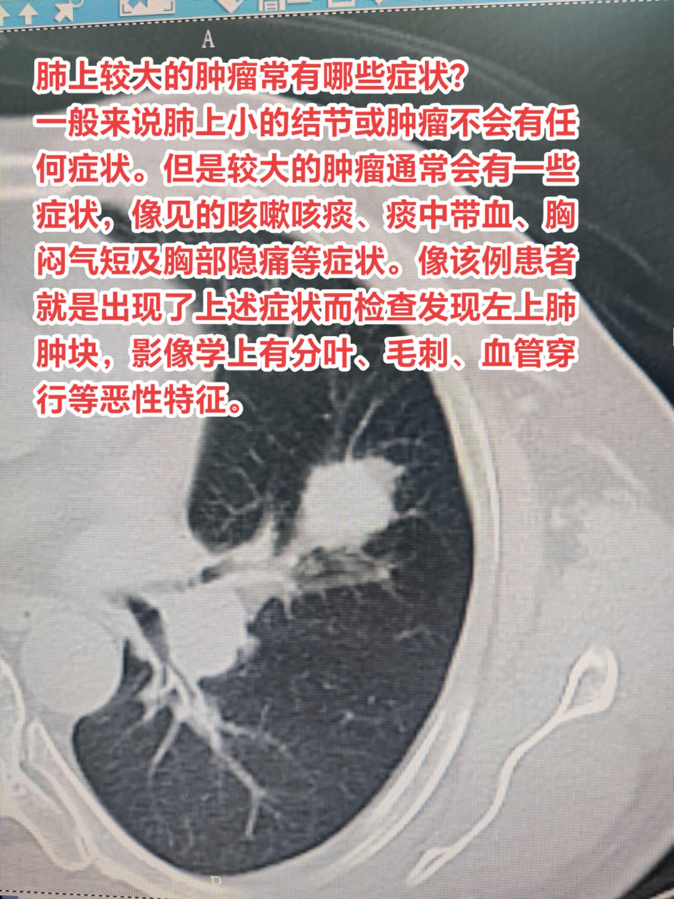 肺上较大的肿瘤常有哪些症状？一般来说肺上小的结节或肿瘤不会有任何症状。...