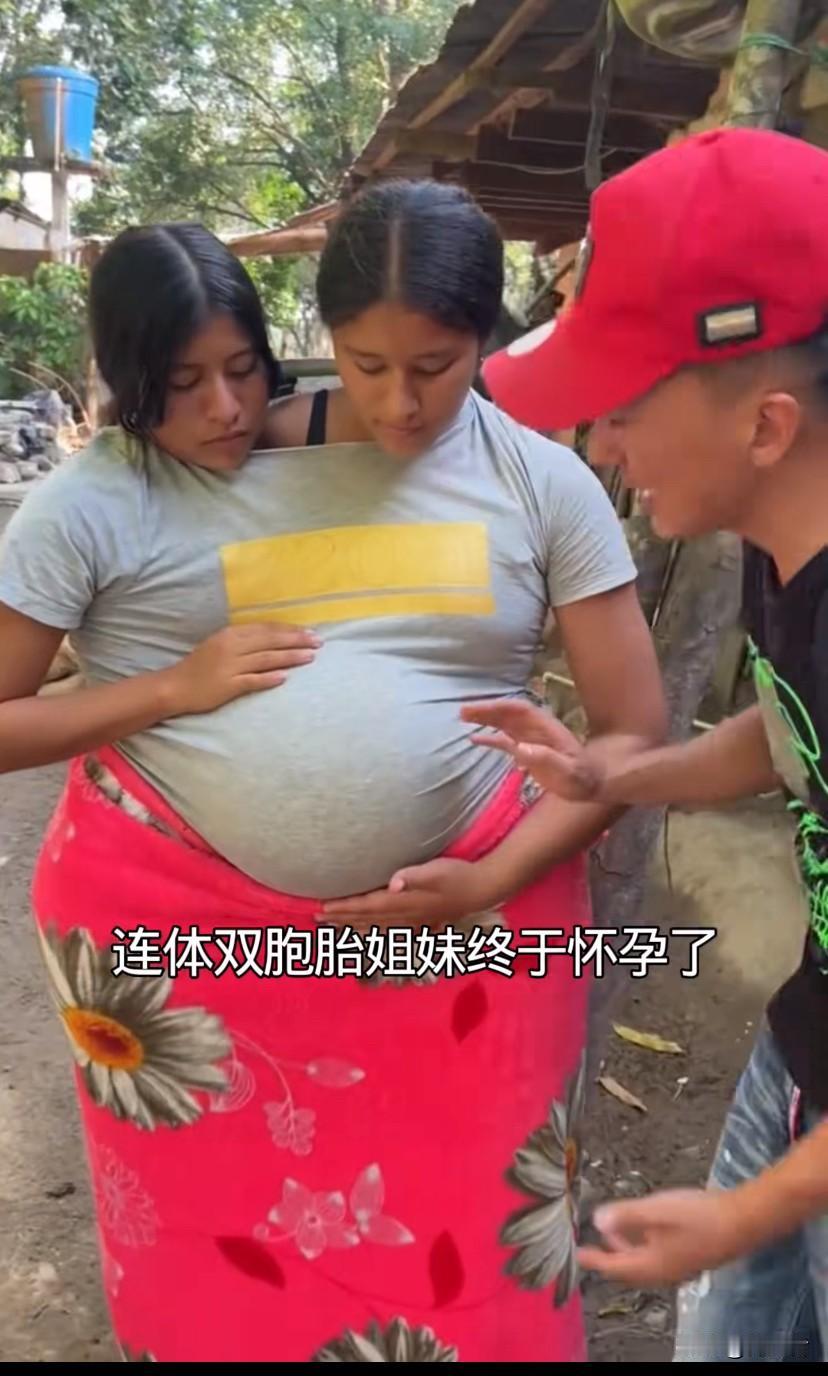 印度连体双胞胎姐妹怀孕，腹部相连，共用肝脏和一套生殖器，只有3条腿。也太难了。