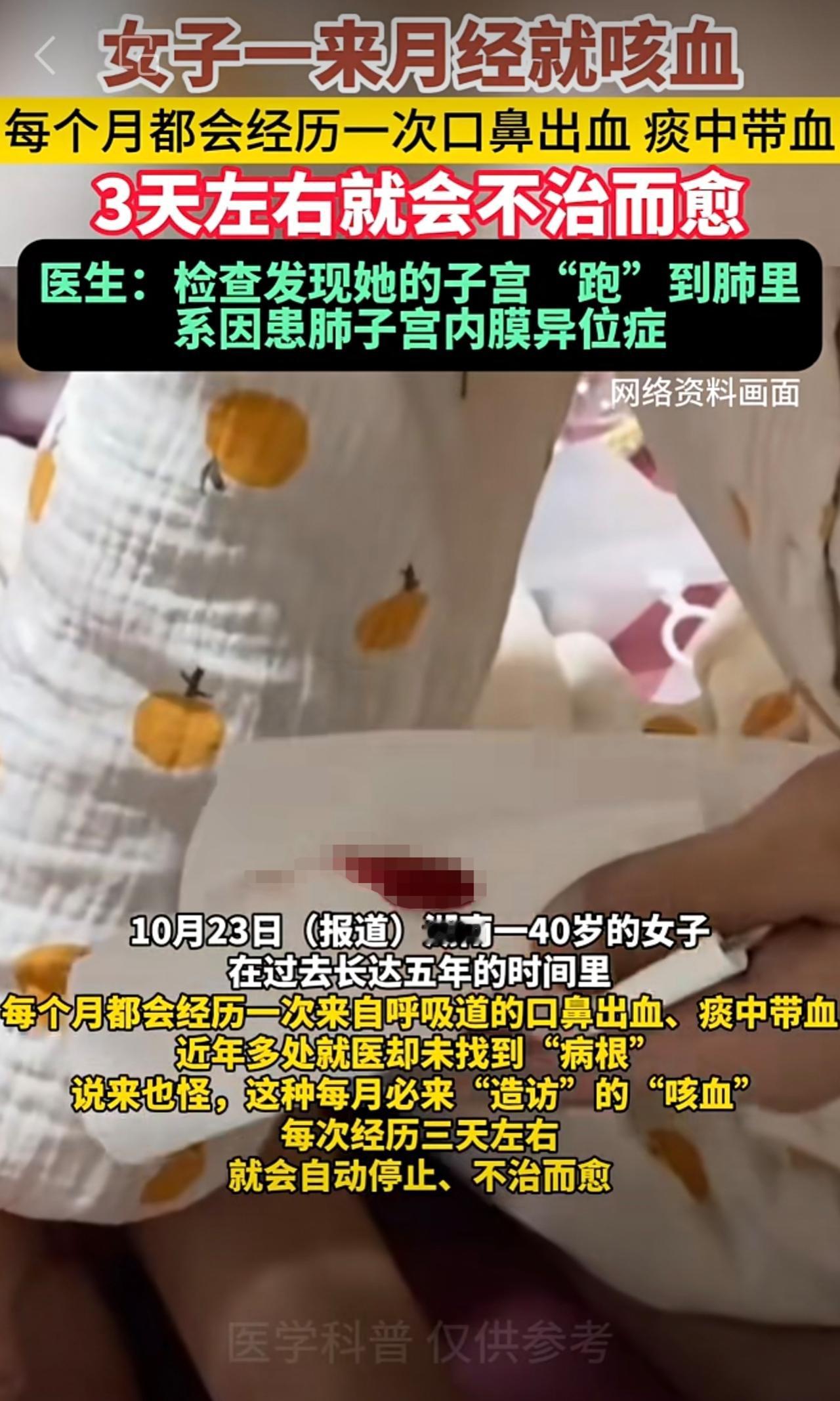 40岁女子在过去长达五年的时间里，每个月都会经历一次来自呼吸道的口鼻出血、痰中带