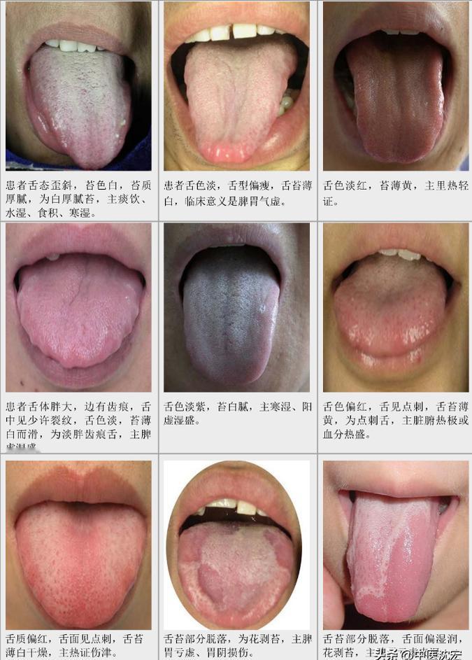 中医看病讲究 “ 望闻问切 ”，舌象就是最为关键的

#养生##中医##健康#