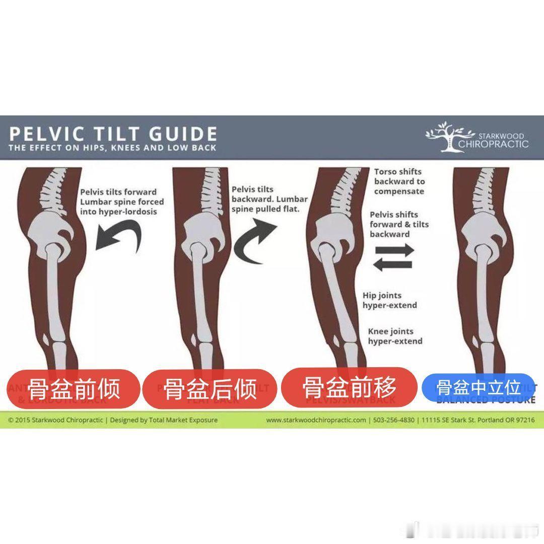 骨盆矫正 你的站姿，是哪种？👇👇【骨盆前倾】——“假翘臀”，让我们的竖脊肌紧