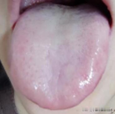 舌苔白腻水滑，理中丸，附子理中丸用了不少，不见好转，反而上火！！

 这其中的关
