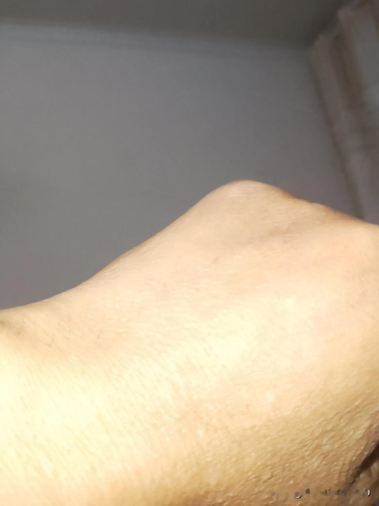 前天，去社区医院免费体检，抽血怎么也查不到下针血管，几针尝试不得不从右手換到左手