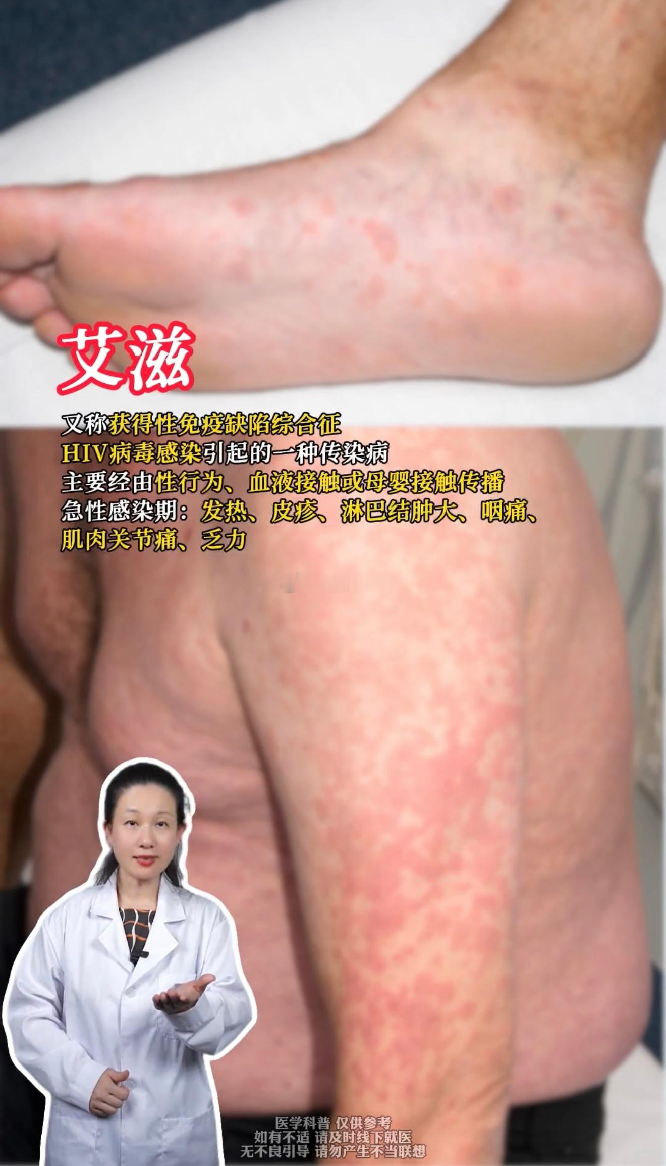 教你识别不同的性病。七夕 ​​​