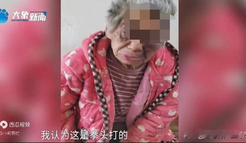 河南漯河，7旬老阿婆居住在养老院期间，家属发现其肋骨断了七根、头上有一条长达20