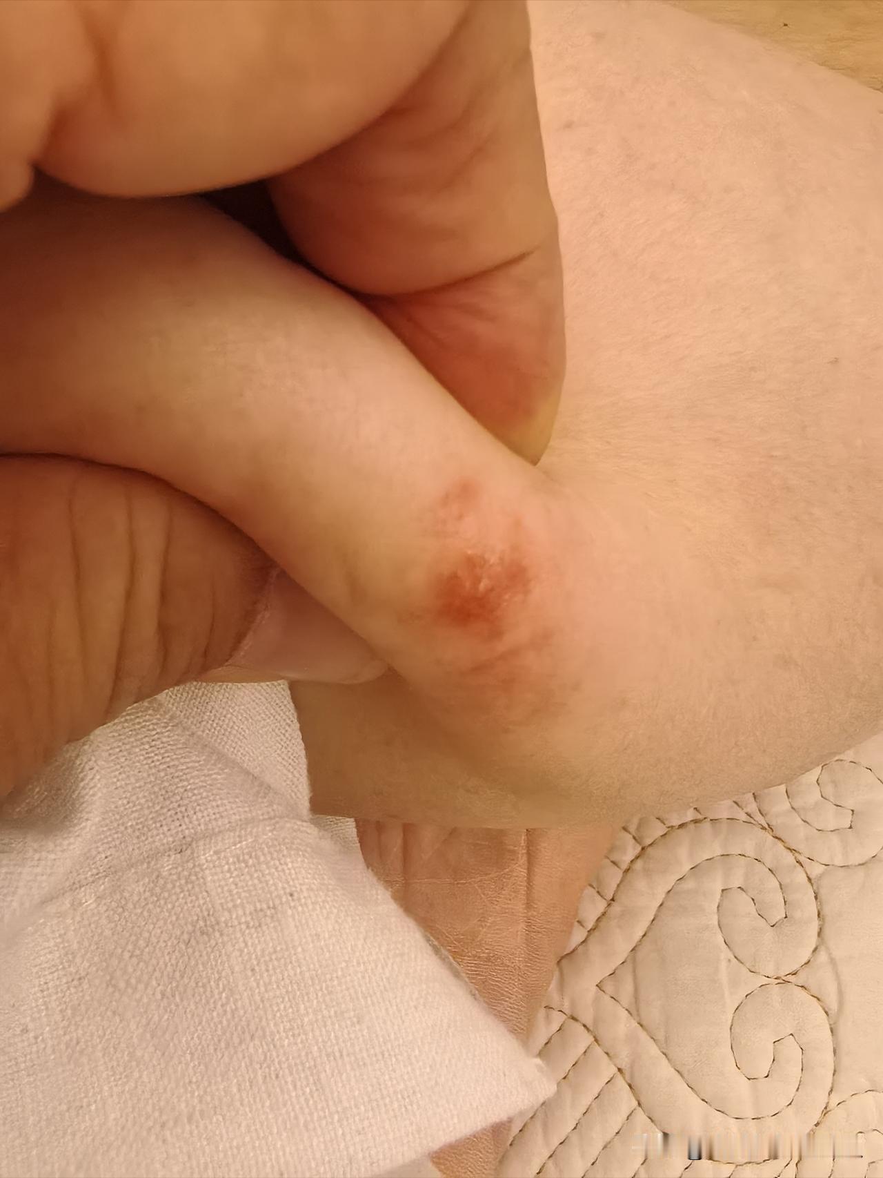 现在的蚊子🦟越来越毒了。

以前年轻的时候，我经常被蚊子🦟咬，相信很多人都被
