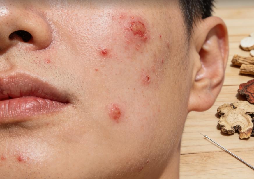 痤疮反复长？中医提醒：不只是上火，或与脏腑失调有关



很多人被反复长痘缠得头