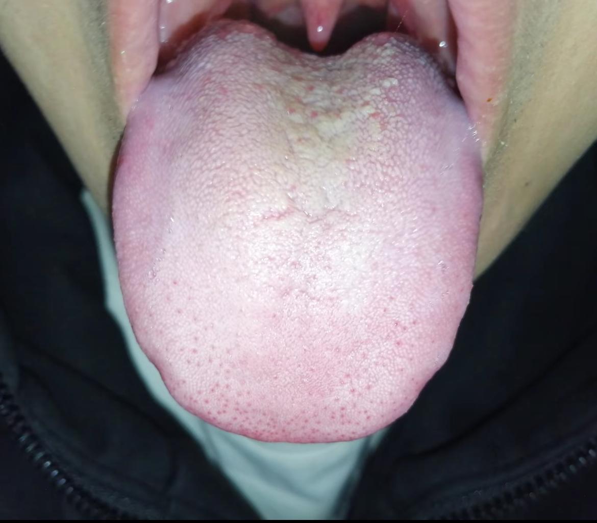 肝郁、脾虚、肾虚、心火旺、让你全占完了
舌头鼓胀，舌中有裂纹，舌根凹陷，黄腻苔
