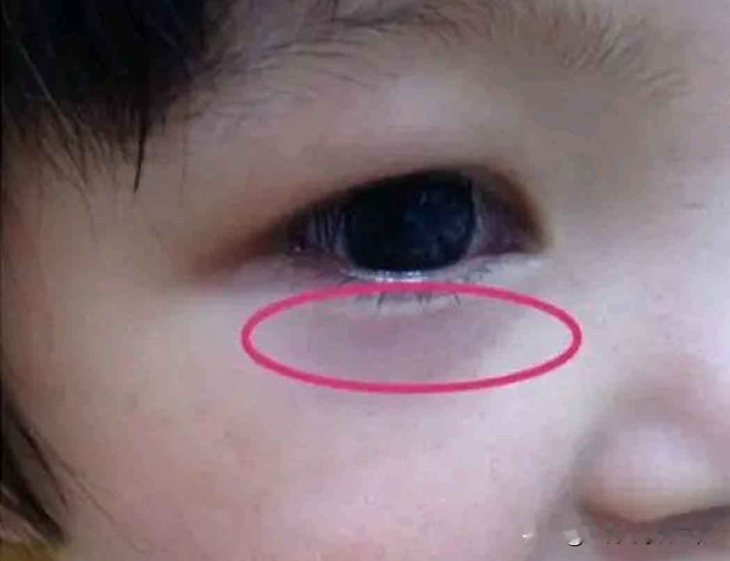 孩子脾胃虚弱，从脸上就能看出来！
 
1、有眼袋
脾胃失常会扰乱气血的正常流转，