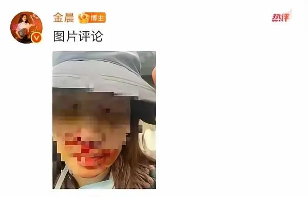 金晨晒脸部受伤照 ，网传了好几天的交通事故争议，她不藏着不掖着，直接晒出脸部带血