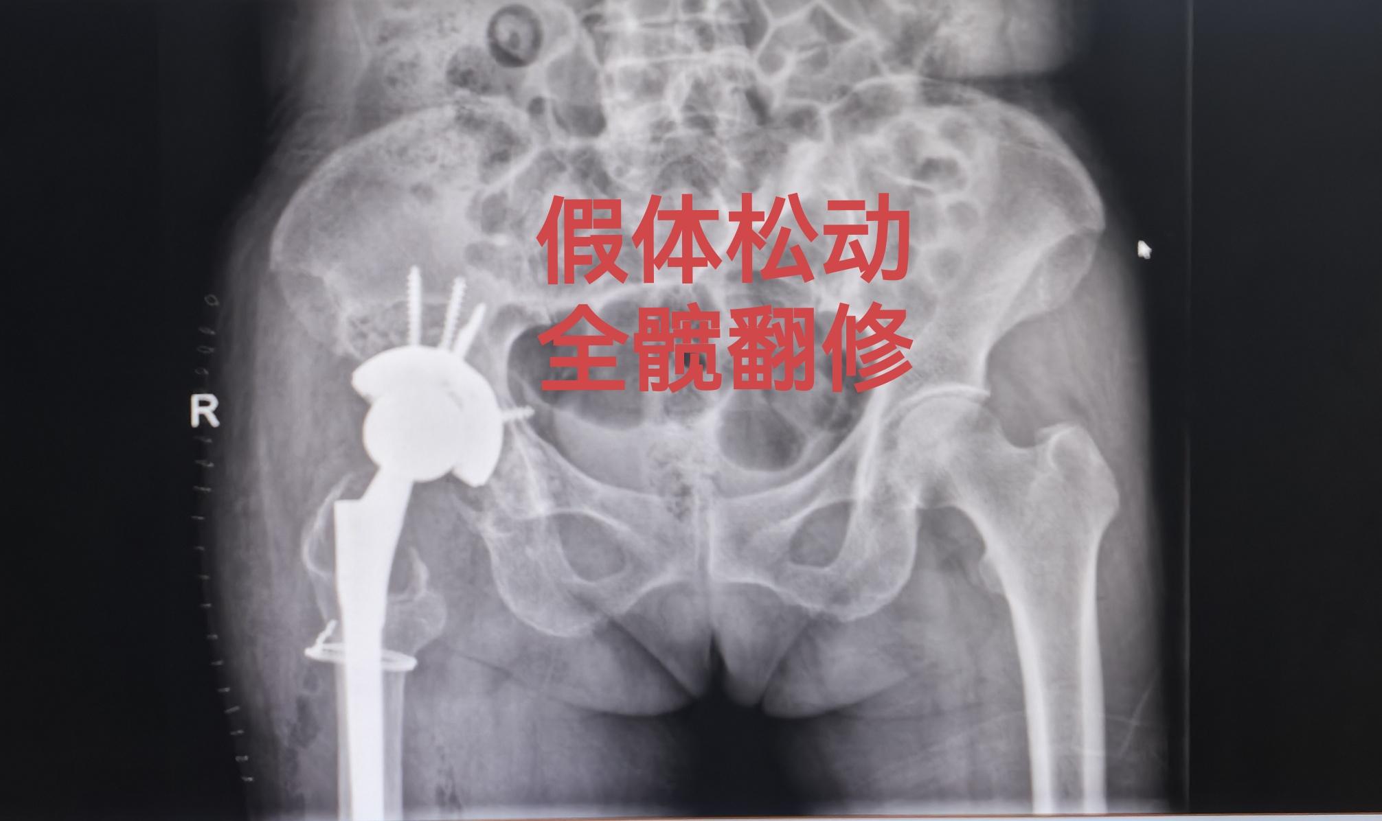 全髋关节翻修术。82岁老太太，THA后（14年）假体松动、骨溶解，全髋...