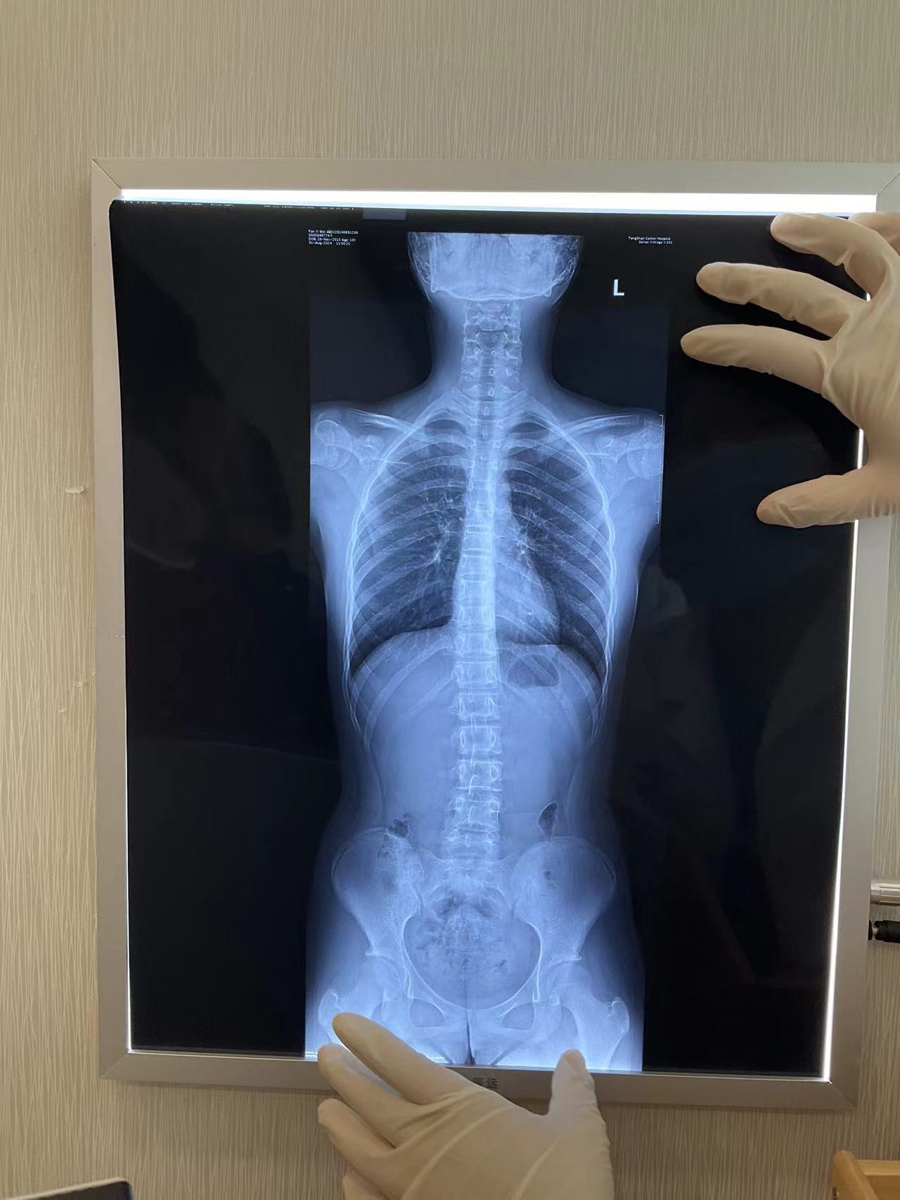 脊柱侧弯  线下接触患者的时候，我们康复师都有一个共同感受：青少年脊柱侧弯的越来