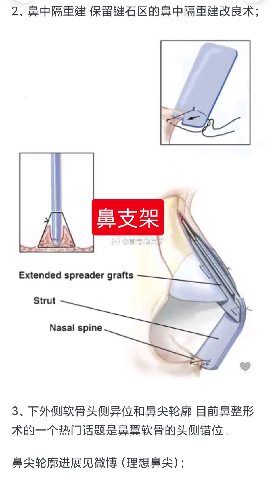 为什么要取肋骨鼻？的原因，为什么要用自体骨骼？为什么肋骨鼻比耳软骨更好？因为肋骨