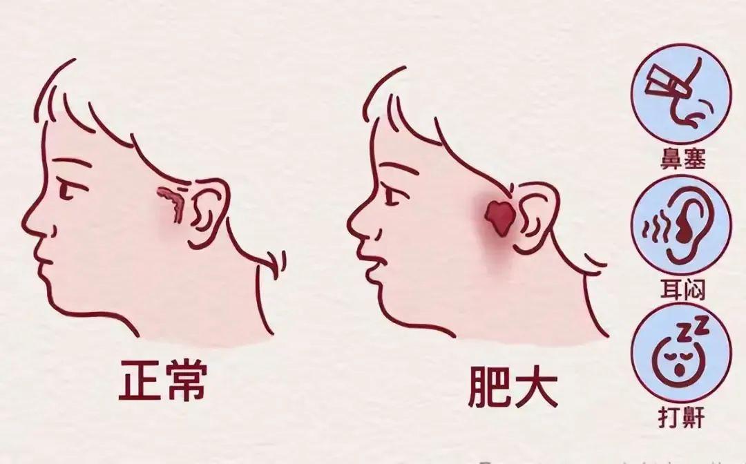 孩子腺样体、扁桃体肥大，这个中成药一定是绕不过去的！
孩子腺样体、扁桃体肥大，很