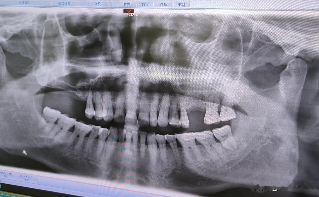 这种血液检查有什么意义

前天公公就说牙疼得不能忍受了，给瘦哥打电话，于是今天我