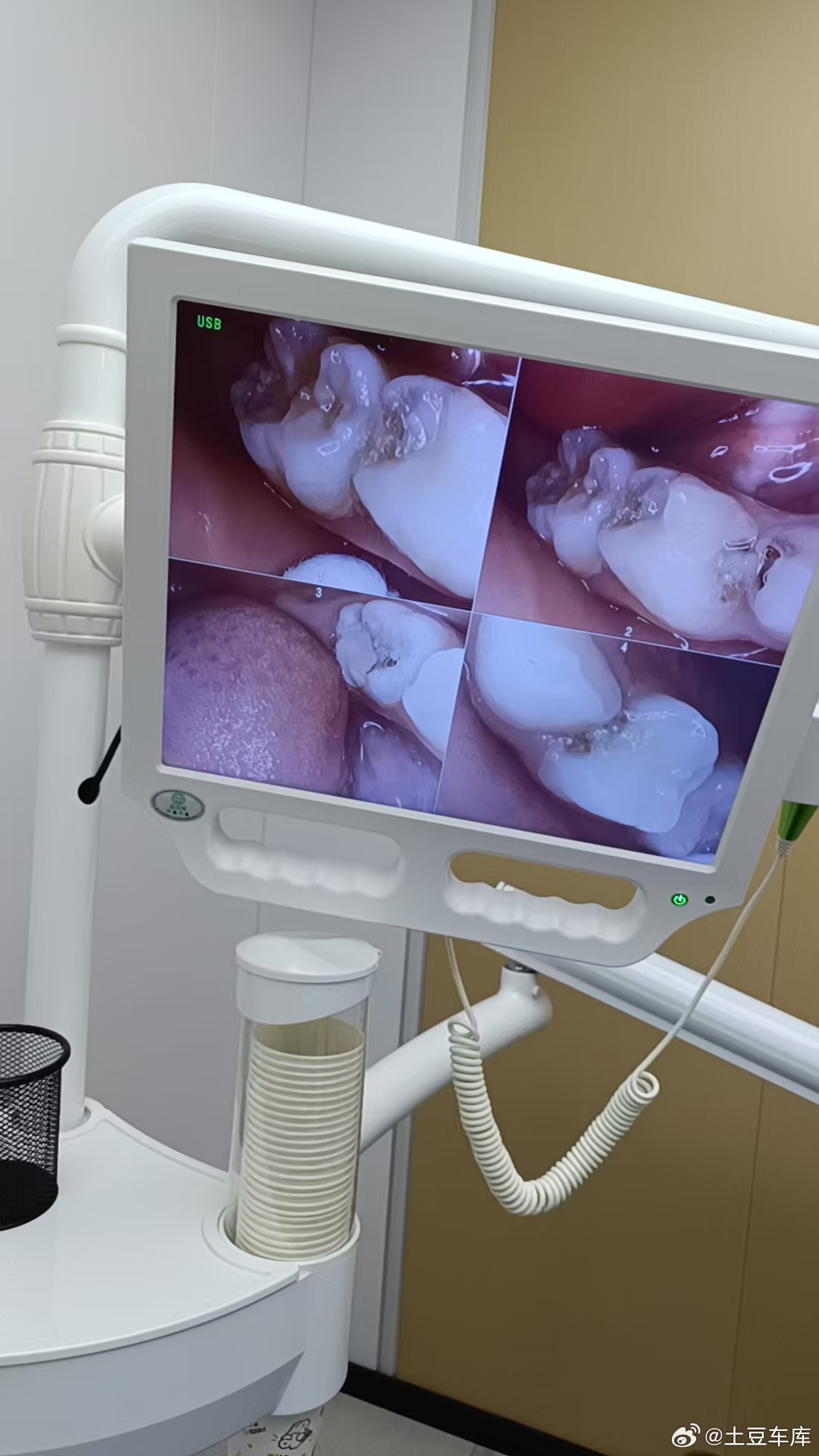 5岁小朋友牙齿坏了 需要补吗 