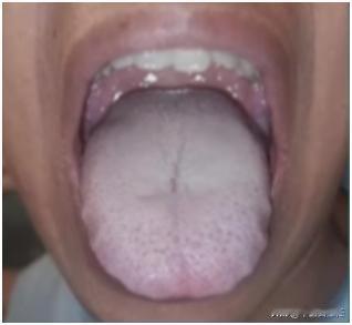 舌头颜色发暗，发紫，不要只会活血化瘀，其实根是阳虚寒湿！
瘀血体质，但是吃血府逐