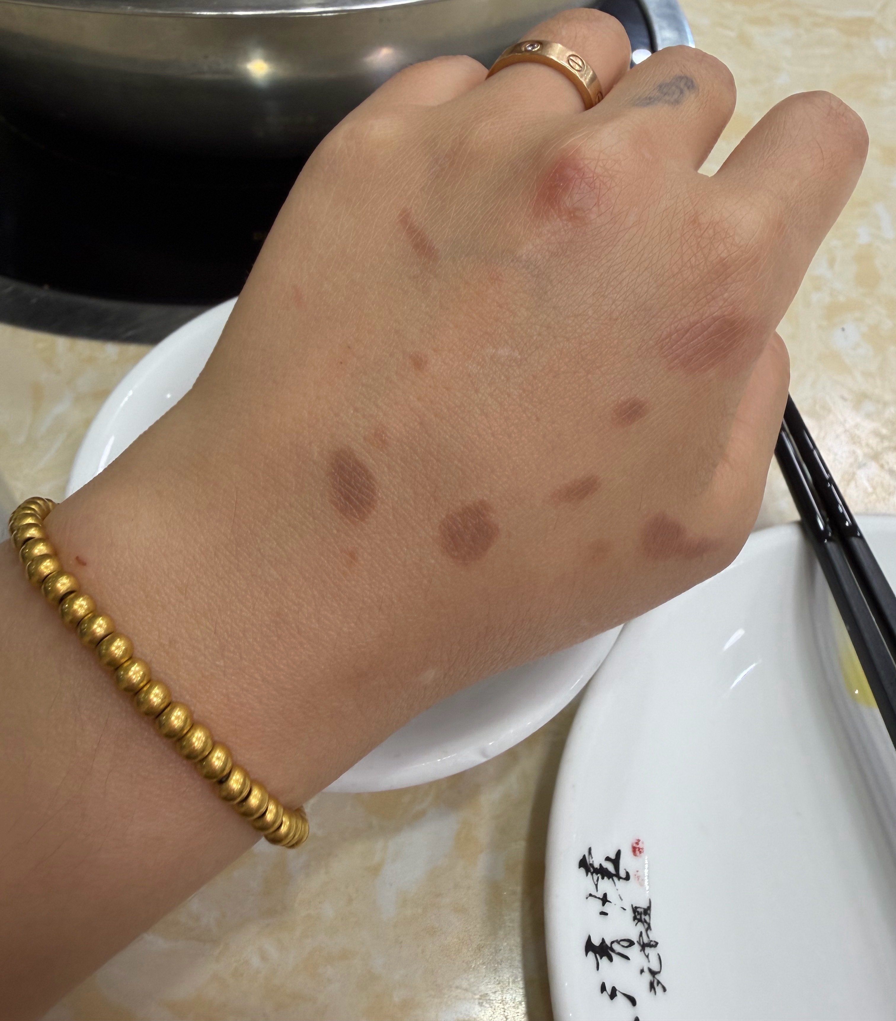 做个饭油溅的整个胳膊都是伤