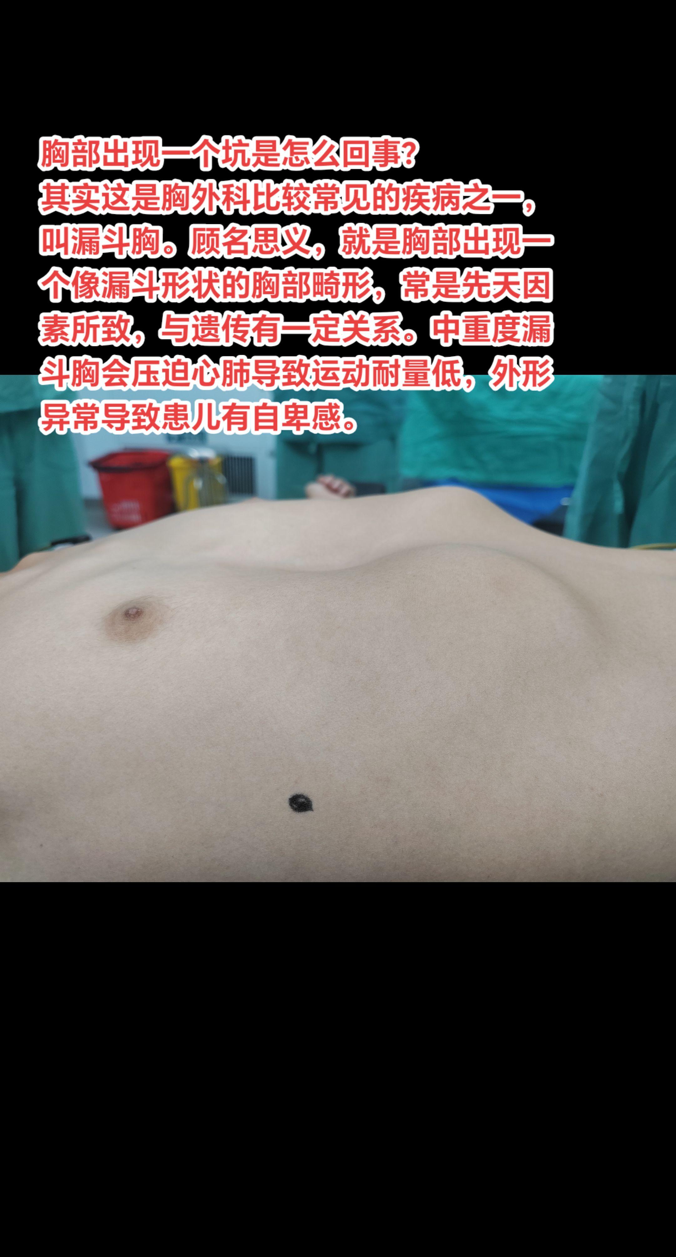 胸部出现一个坑是怎么回事？其实这是胸外科比较常见的疾病之一，叫漏斗胸。...