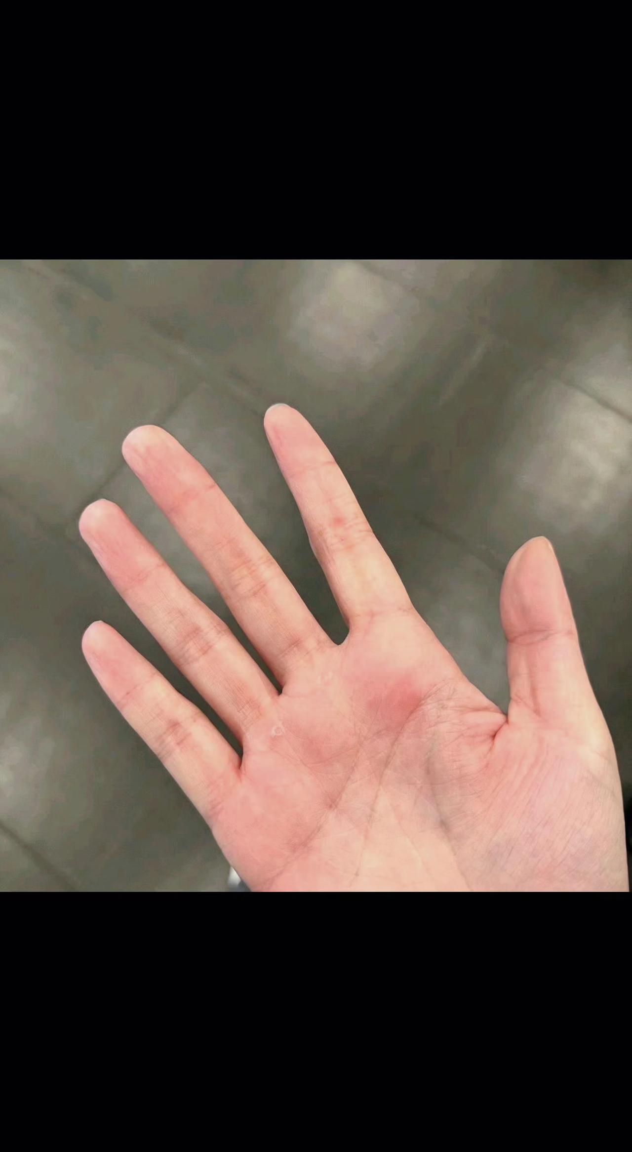 ✊这层硬茧是时光的印章吧？握得住梦想的重量✨ 痛过才懂，成长从不是华丽的词藻