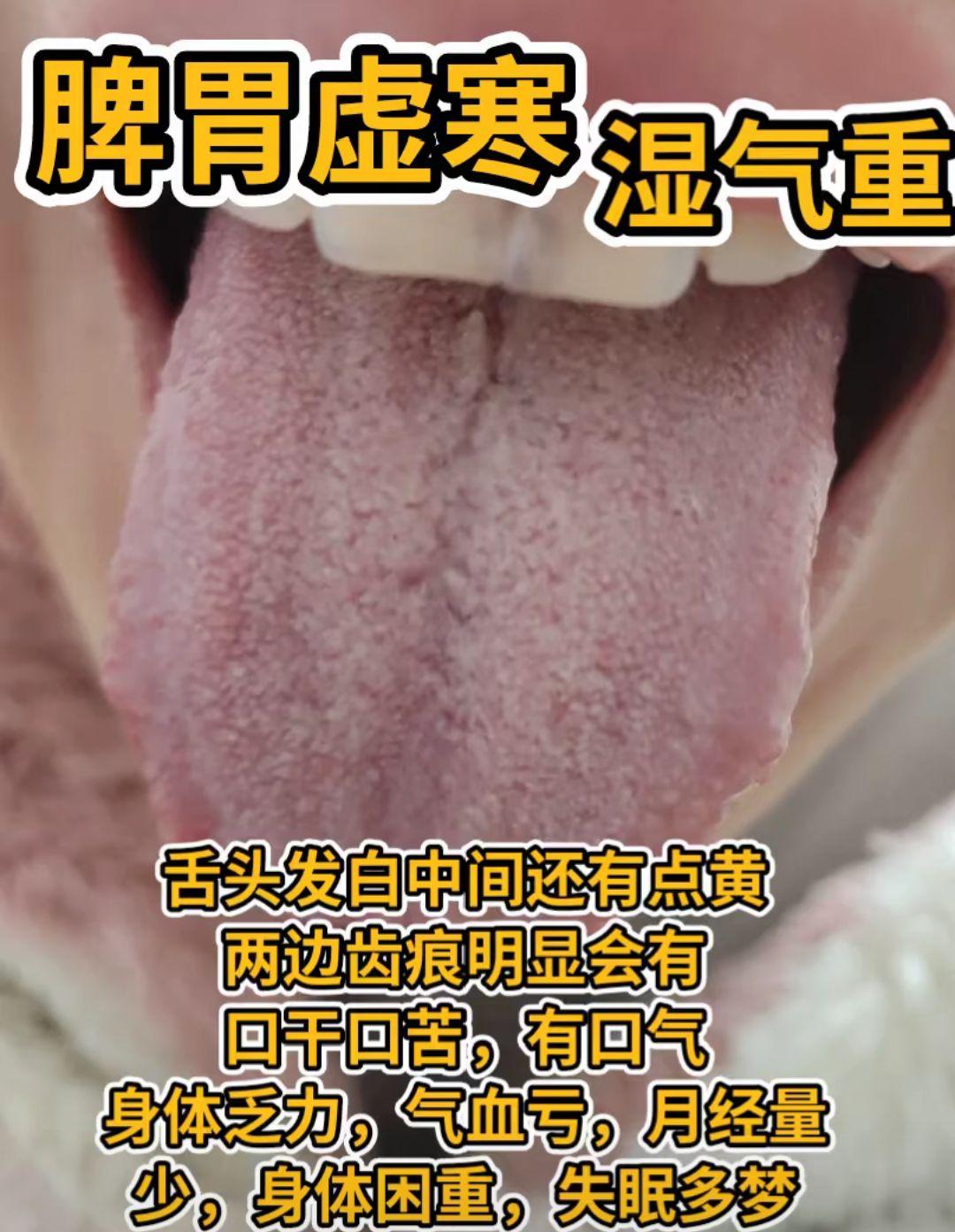 齿痕舌的四种舌象分析