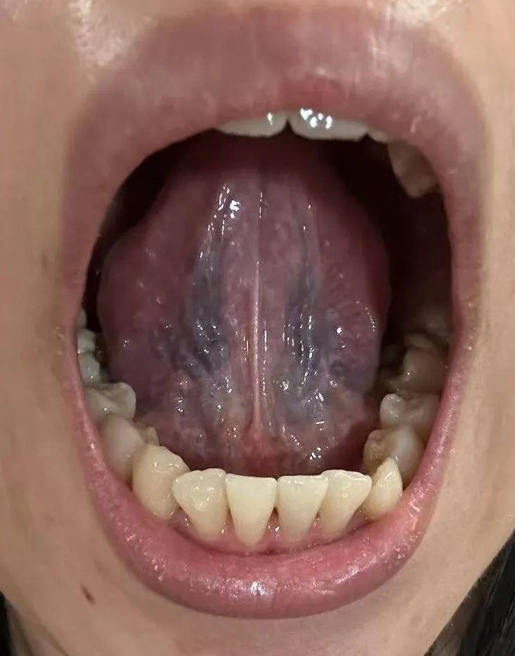 看到这个舌下静脉的照片，你们看血液有没有问题？

学医的都知道，一般静脉血虽然暗