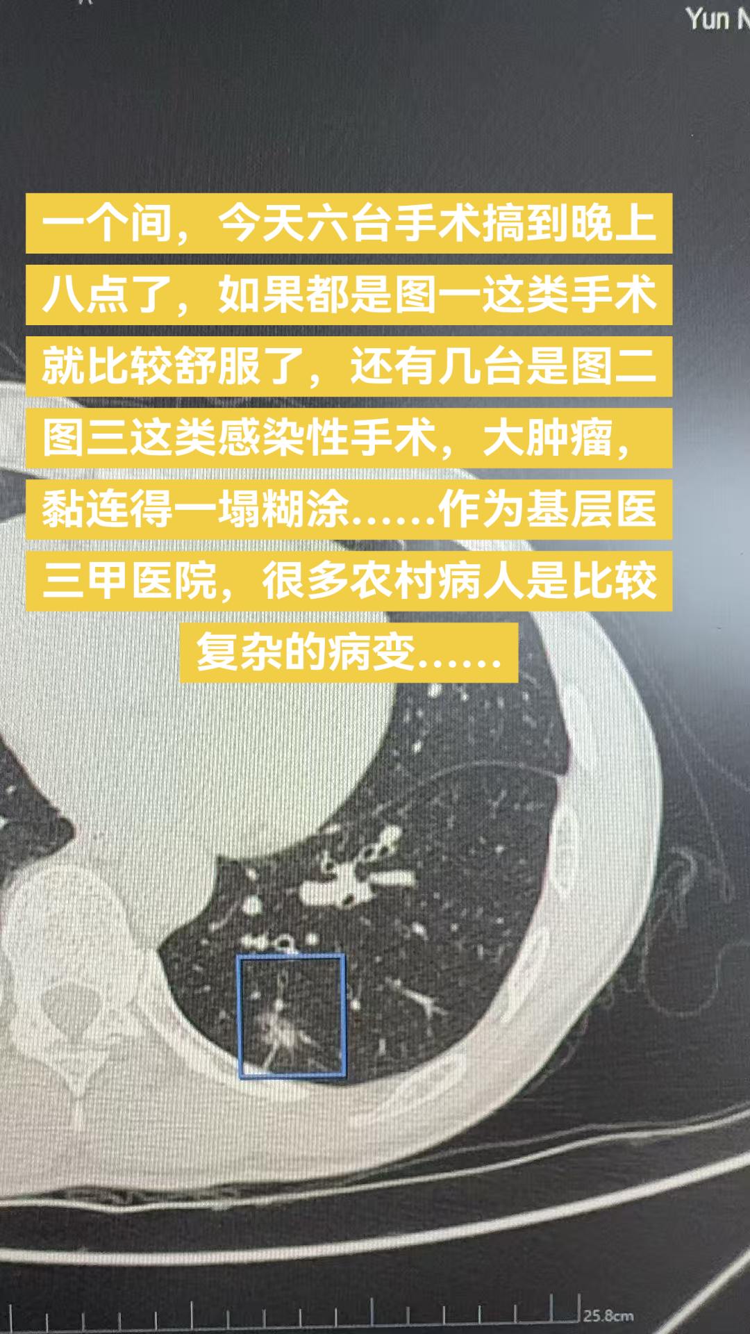 一个间，今天六台手术搞到晚上八点了，如果都是图一这类手术就比较舒服了...