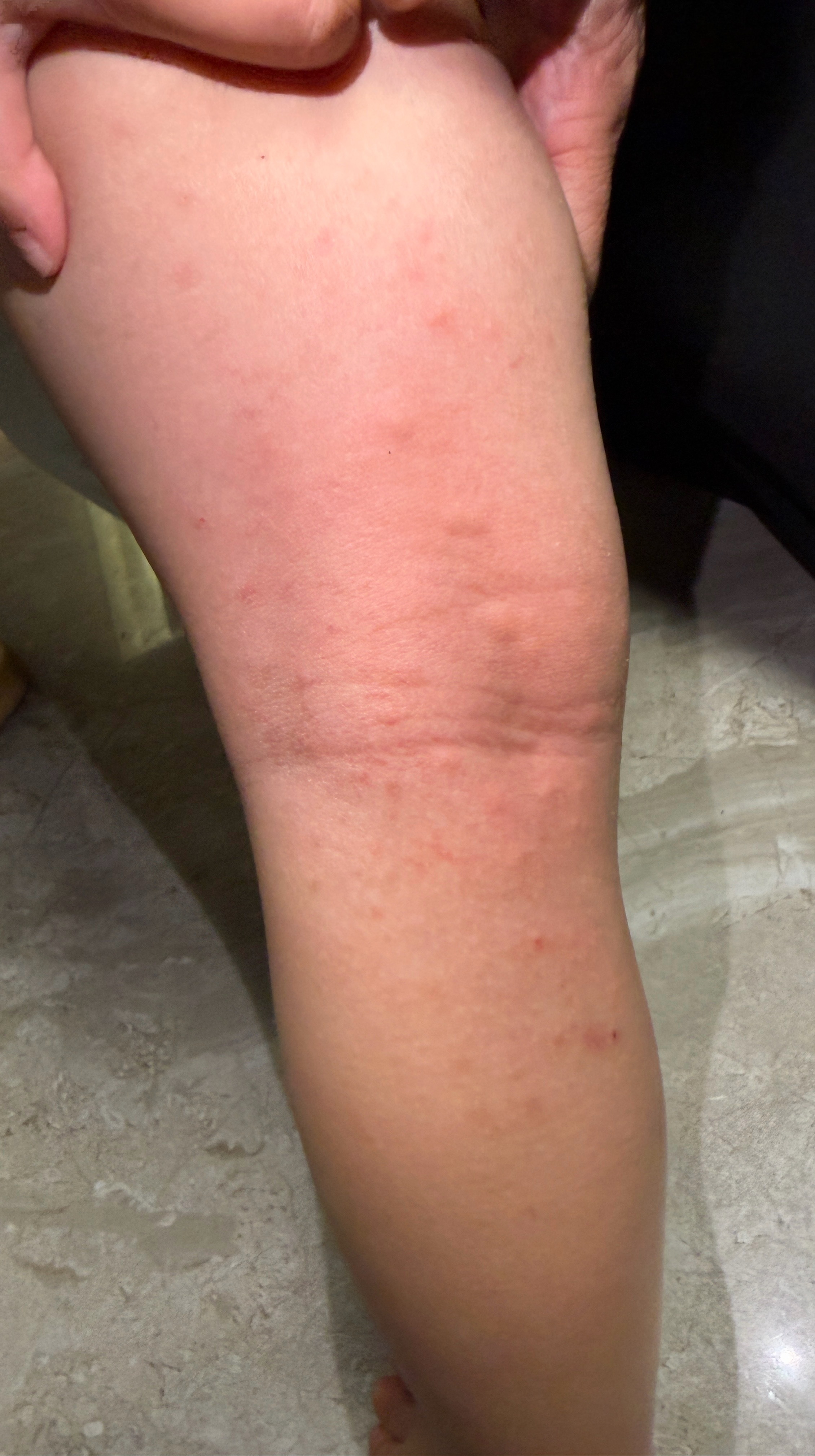 经常收到网友们私信，问阿琛腺样体治疗过程。我之前写了带阿琛看病过程，目前还在治疗