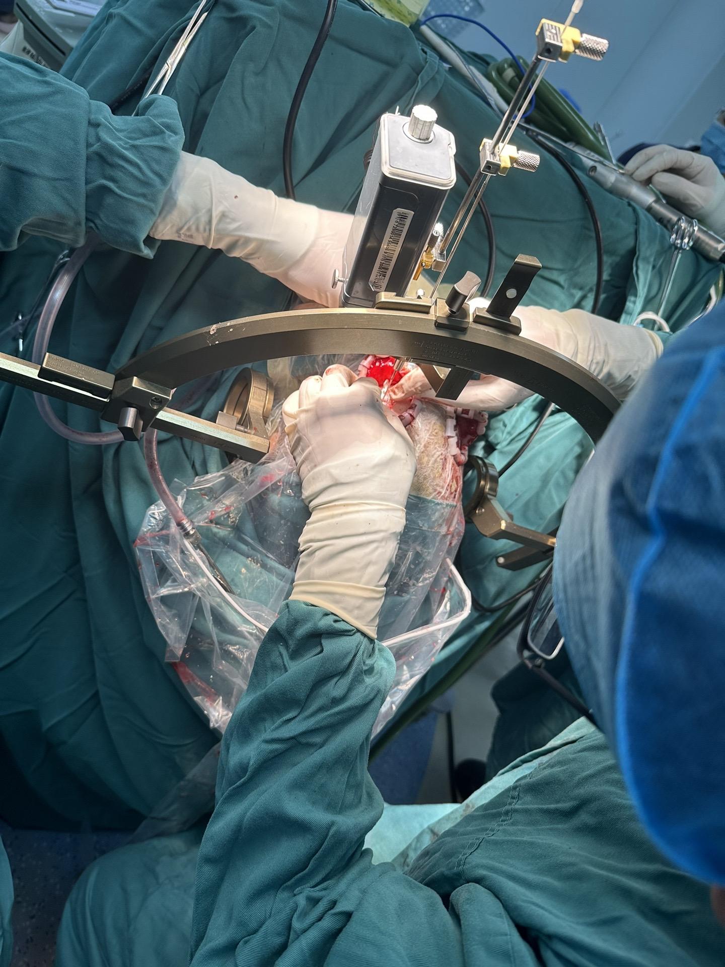 帕金森病手术治疗。帕金森病如果符合适应症，建议手术治疗改善症状、延缓病...