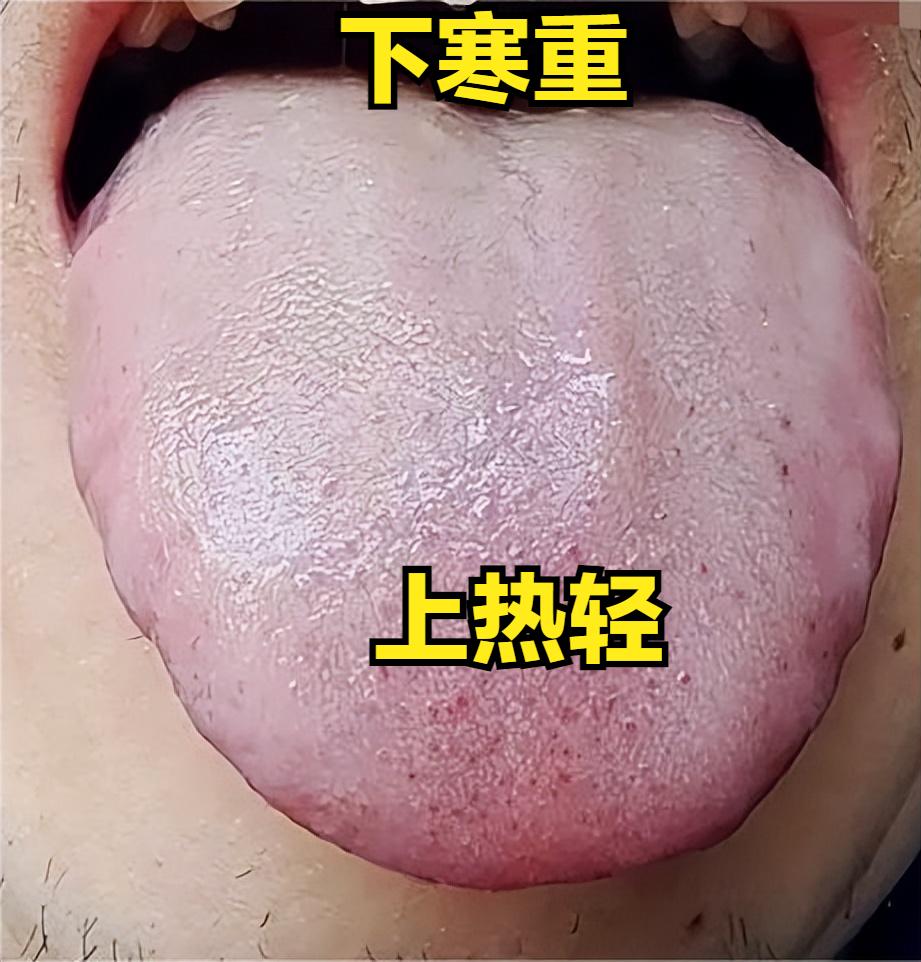 上热下寒，你是热重？还是寒重？教你看舌象解决。

1、上热轻，下寒重
舌象：舌苔