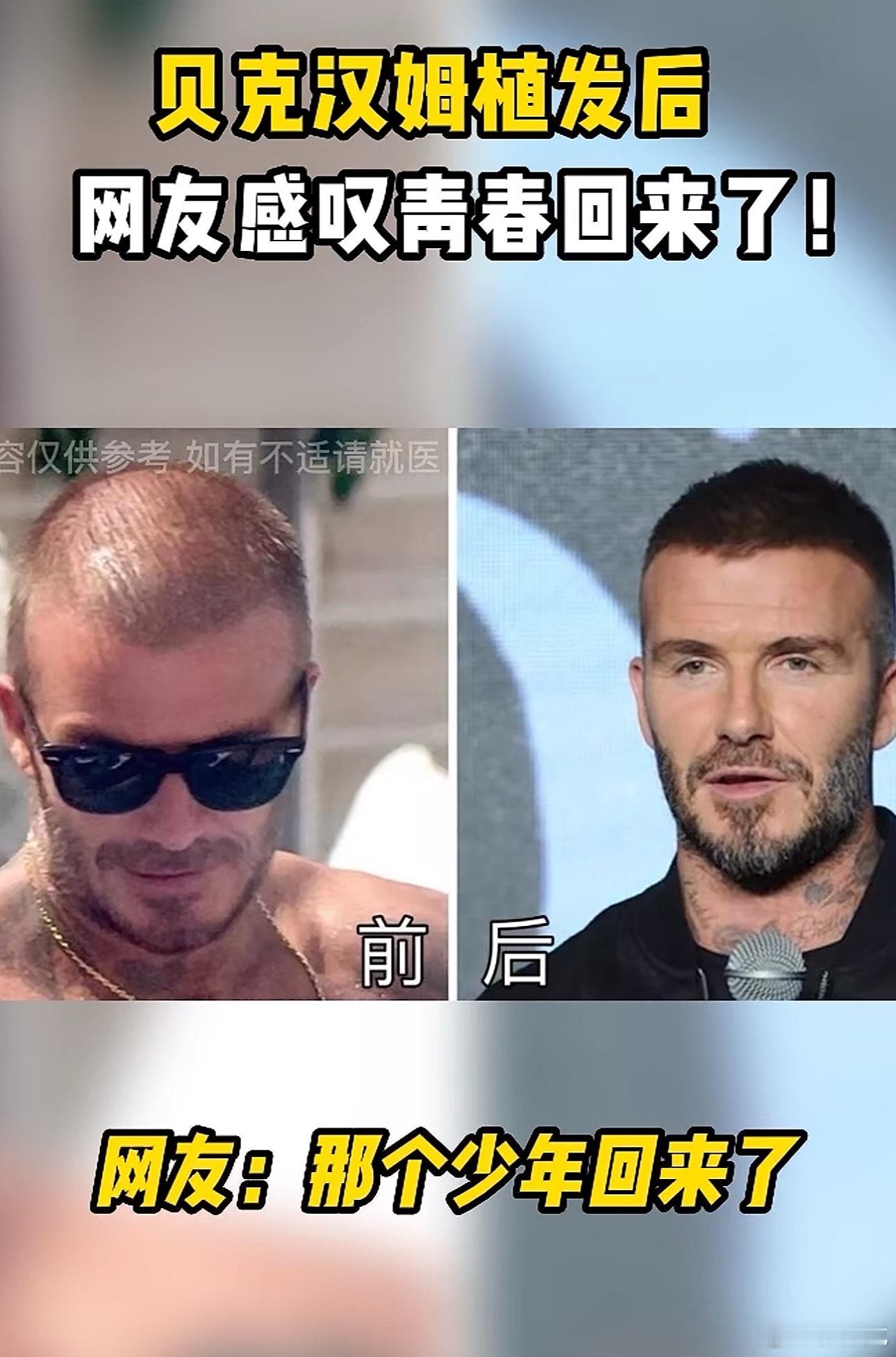 贝克汉姆秃顶了几年前就传出贝克汉姆去做了植发手术只是他本人从来没有承认过