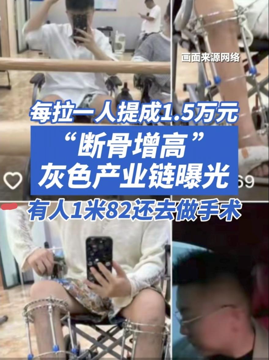 断骨增高被曝光，挖出的细节：
 
1、断骨增高手术是明令禁做的医美黑手术，只允许