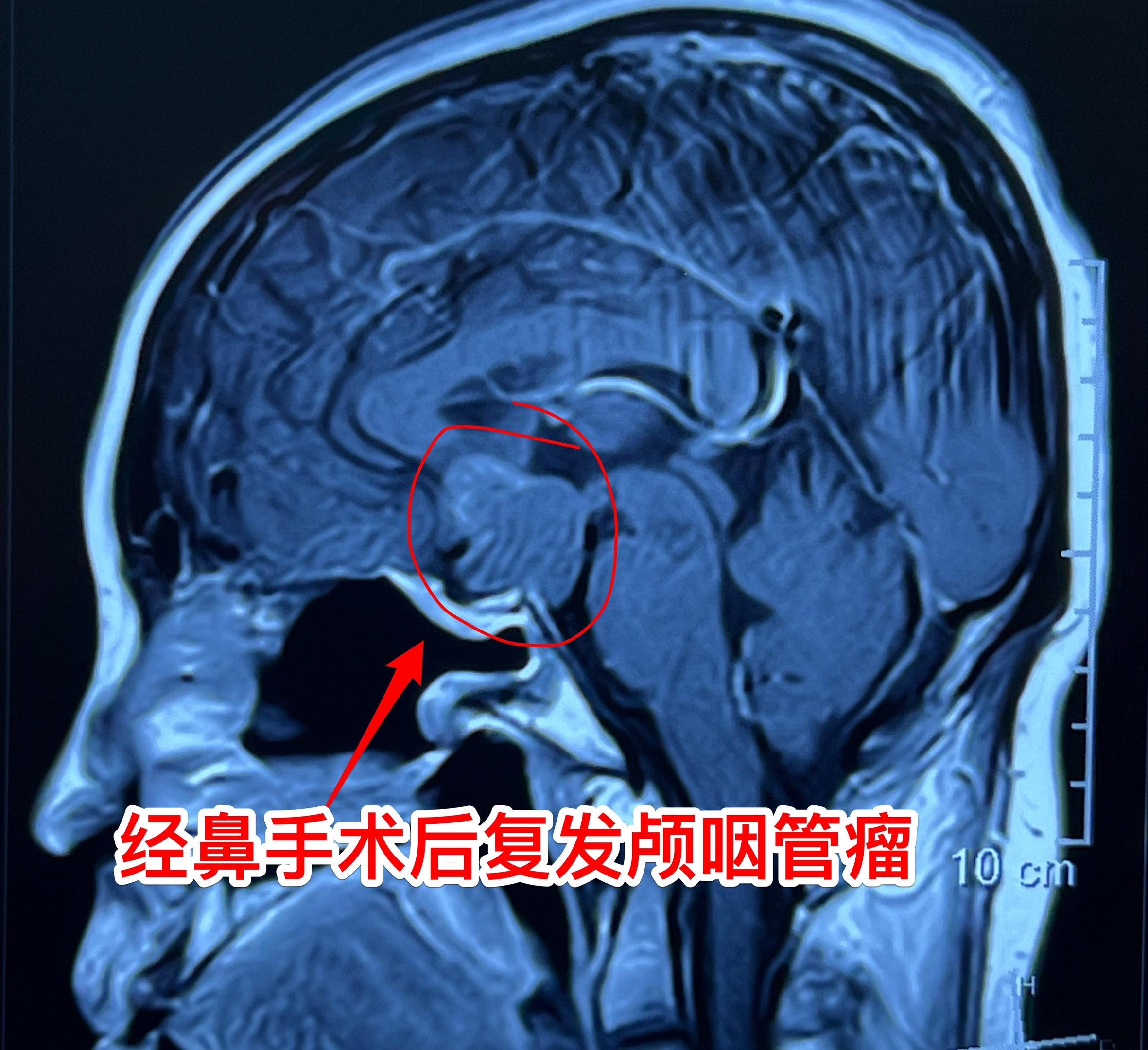 复发颅咽管瘤也要争取完全切除。50岁东北女性，颅咽管瘤经鼻手术后一年复...