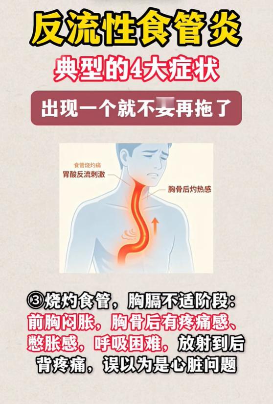 烧心反酸不一定小事，反流性食管炎分 4 个阶段