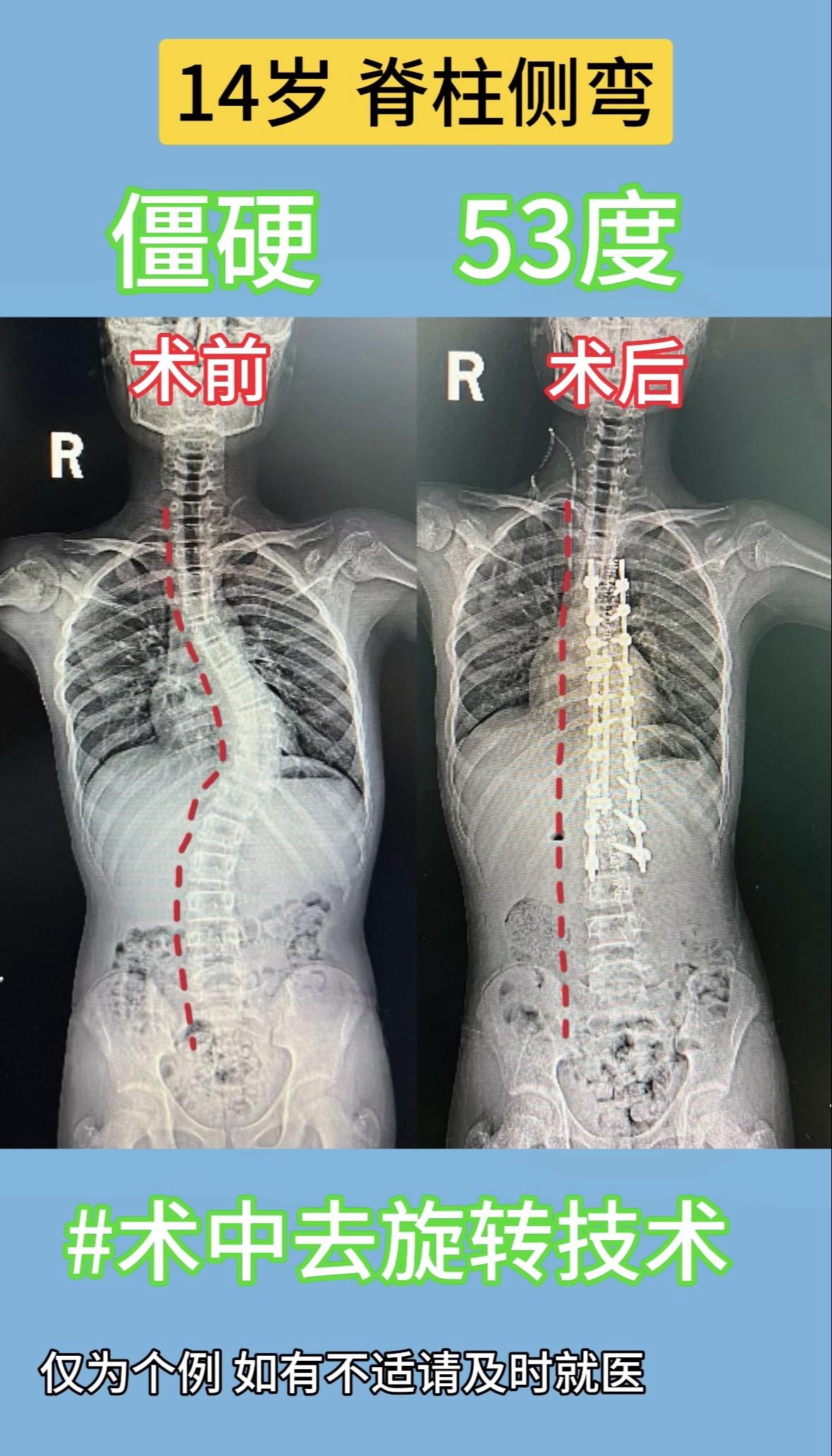 14岁，脊柱侧弯，僵硬。53度，通过术中去旋转技术，左侧高肩胛得到极大...